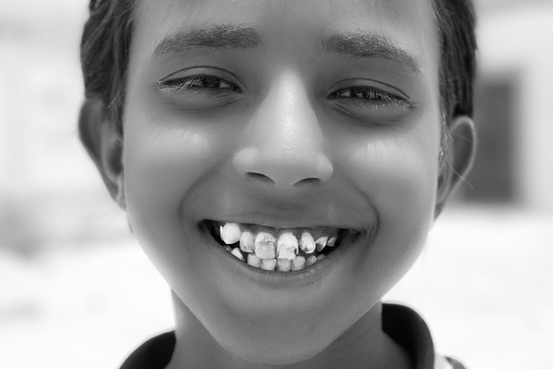 Human Right to Water in India - Dental fluorosis resulting from consumption of fluoride-rich water from the piped water scheme shown before in Bikaner district, Rajasthan